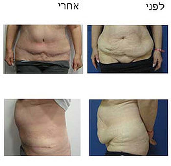 מתיחת בטן לפני ואחרי