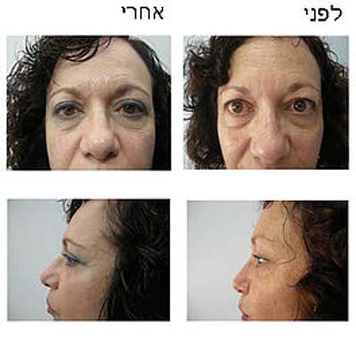 ניתוחי עפעפיים לפני ואחרי