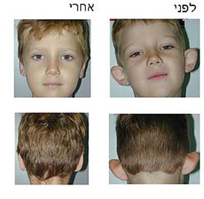 הצמדת אוזניים - לפני ואחרי