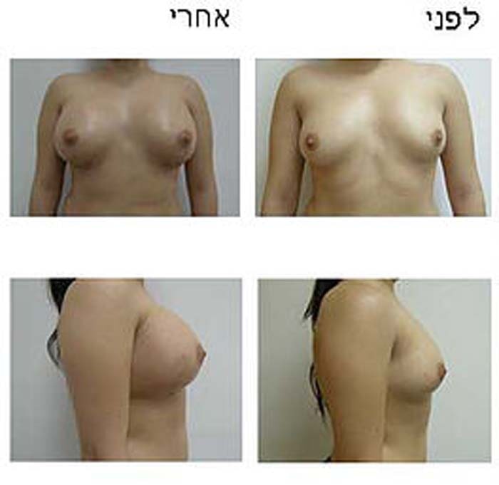 הגדלת חזה - דר שופאני עזיז – מומחה לכירורגיה פלסטית