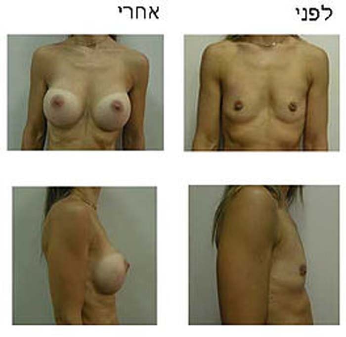 הגדלת חזה - לפני ואחרי