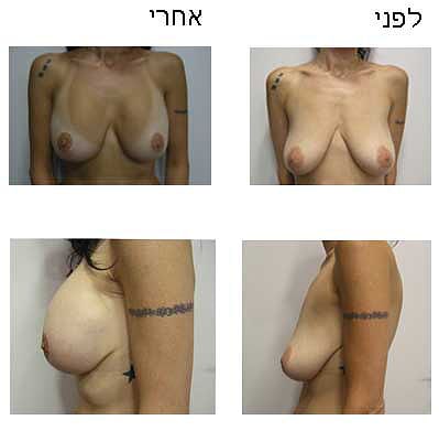 הרמת חזה - דר שופאני עזיז – מומחה לכירורגיה פלסטית
