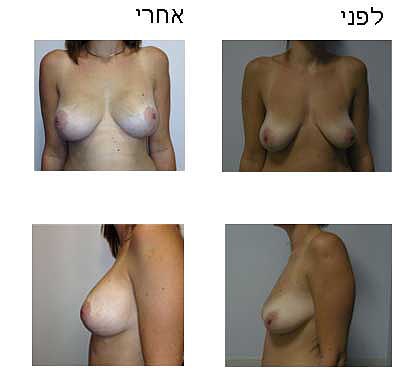 הרמת חזה - לפני ואחרי